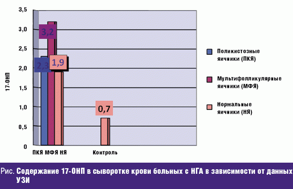 Рис. Содержание 17-ОНП в сыворотке крови больных с НГА в зависимости от данных УЗИ