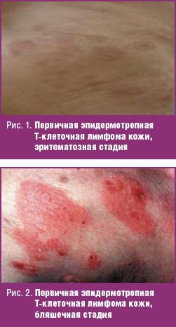 Первичная эпидермотропная Т-клеточная лимфома кожи, эритематозная стадия