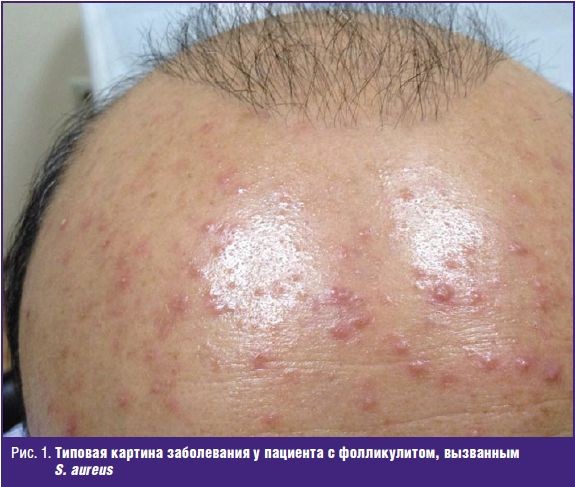 Типовая картина заболевания у пациента с фолликулитом, вызванным S. aureus