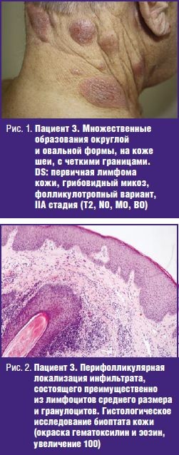 первичная лимфома кожи, грибовидный микоз, фолликулотропный вариант