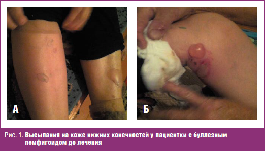 Высыпания на коже нижних конечностей у пациентки с буллезным пемфигоидом до лечения