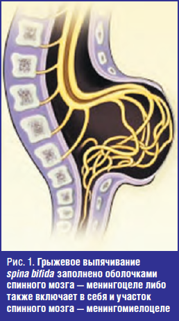 Грыжевое выпячивание spina bifida заполнено оболочками спинного мозга — менингоцеле либо также включает в себя и участок спинного мозга — менингомиелоцеле
