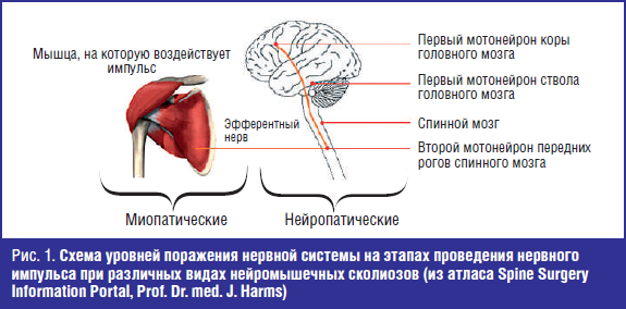 Схема уровней поражения нервной системы на этапах проведения нервного импульса при различных видах нейромышечных сколиозов