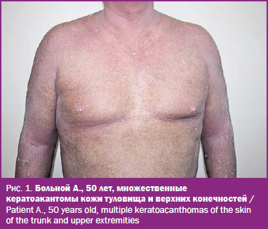 Больной А., 50 лет, множественные кератоакантомы кожи туловища и верхних конечностей