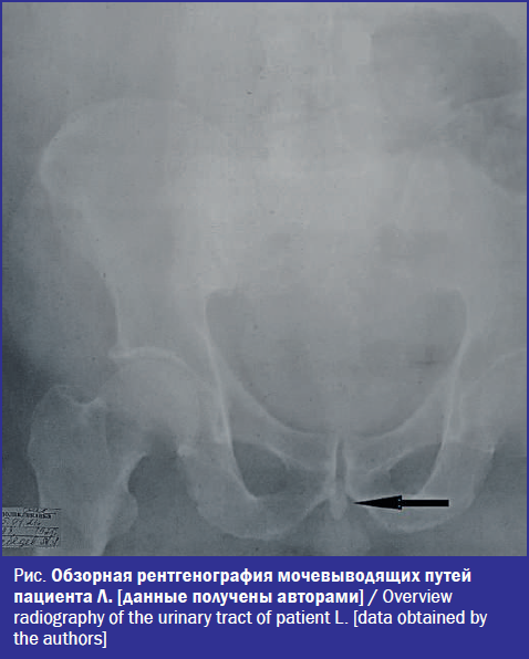 Обзорная рентгенография мочевыводящих путей пациента Л.
