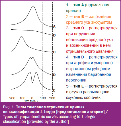 Типы тимпанометрических кривых по классификации J. Jerger
