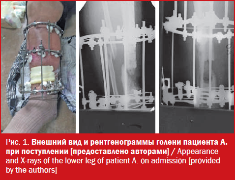 Внешний вид и рентгенограммы голени пациента А. при поступлении