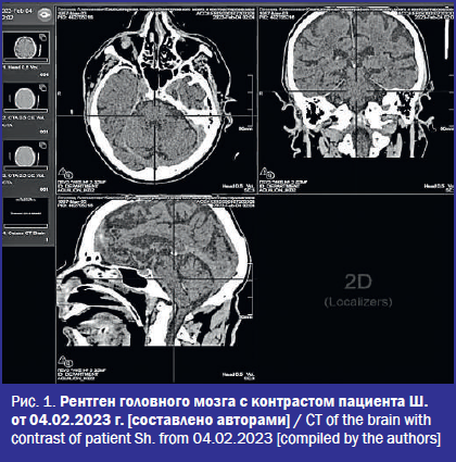 Рентген головного мозга с контрастом пациента Ш. от 04.02.2023 г.