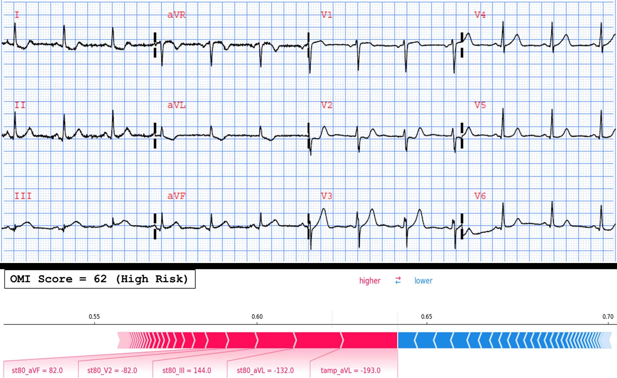 Диагностика инфаркта миокарда с помощью нового алгоритма машинного обучения