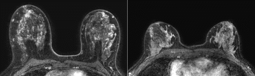 Новый МРТ-маркер рака молочной железы