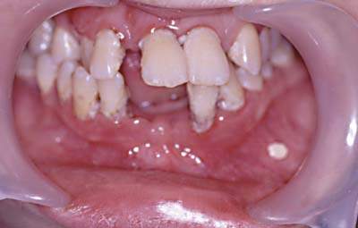 Быстропрогрессирующий пародонтит у детей стоматология томск ивана черных 109