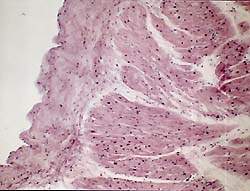 Сердечно сосудистая система при ревматоидном артрите thumbnail