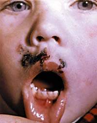 Диагностика острого герпетического стоматита у детей