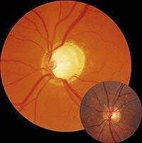 Глаукома в практике семейного врача
