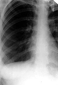 Характеристика кашля при туберкулезе: