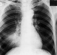 Различия в характере кашля при туберкулезе и бронхите